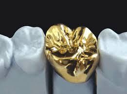 Full crown Cast metal, tooth shaped cover