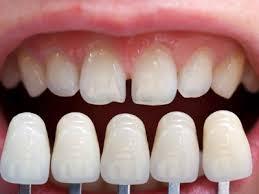Indirect veneer Tooth