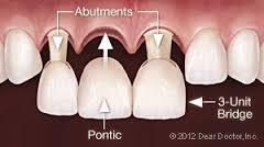 Pontic Artificial tooth part