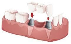 Abutment Natural tooth or teeth