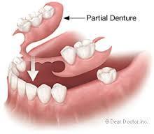 Partial denture A