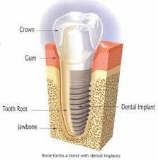Root form implant-endosseous
