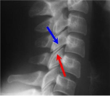 Unilateral facet dislocation Mechanism: flexion, combined flexion/ rotation Anterior dislocation of one vertebral body by