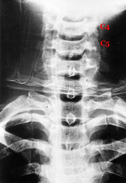 Unilateral Facet Dislocation AP view- spinous processes of the vertebrae