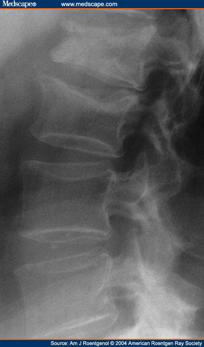 Thoracic Compression Fracture Unstable if: Loss of vertebral ht >