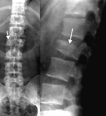 Lumbar Spine Injury Lower lumbar spine is the most mobile Isolated fractures of the lower lumbar spine rarely