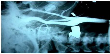 Penetrating Spine Trauma Majority caused by gunshot wounds. Most gunshot wounds result in stable vertebral injuries Cord lesions are often complete.