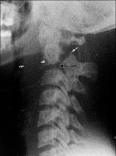 Hangman s Fracture Most common fracture of C2