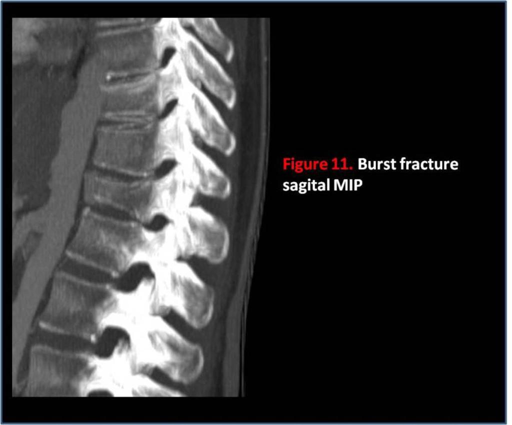 Fig. 11: Burst fracture