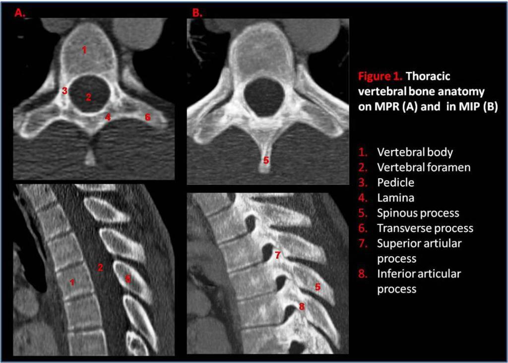 Fig. 1: Thoracic