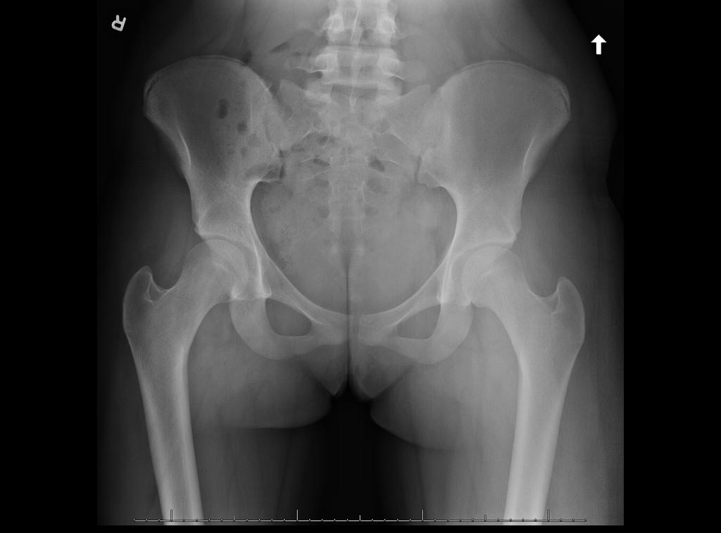 Background Patient reported outcomes, complications and intra-articular pathology have been reported in small series of patients who have undergone hip preservation surgery