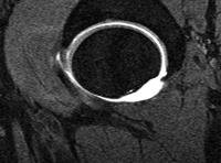 The presence of chondral lesions alone on MRI scans is not a contraindication for surgical treatment of FAI with surgical dislocation of the hip, but the results are less predictable.