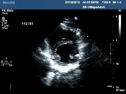 Restrictive Mitral Inflow with Respiratory