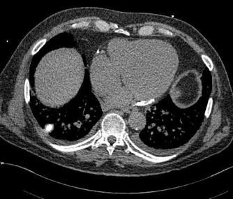 71 yo man with RUQ discomfort and dyspnea 2 years after