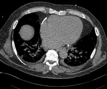 Peripheral edema CT was obtained: Calcified Pericardium