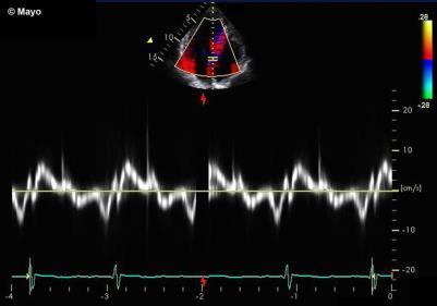 Mitral inflow E= 0.8 A= 0.