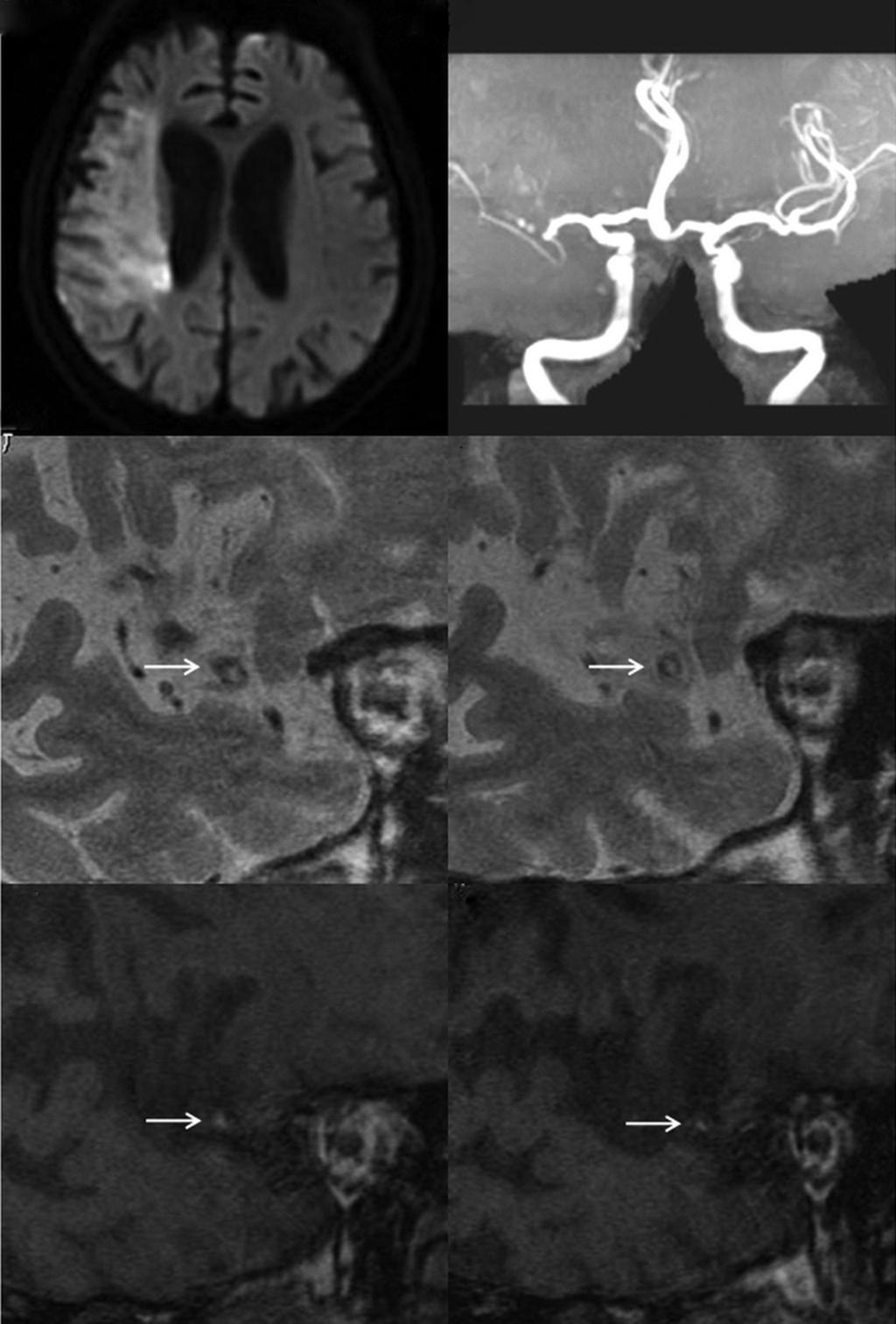 Annals of Translational Medicine, Vol 2, No 8 August 2014 Page 3 of 6 A B C D E F Figure 1 A patient with a large territory infarct (A) due to right middle cerebral artery (MCA) occlusion (B).