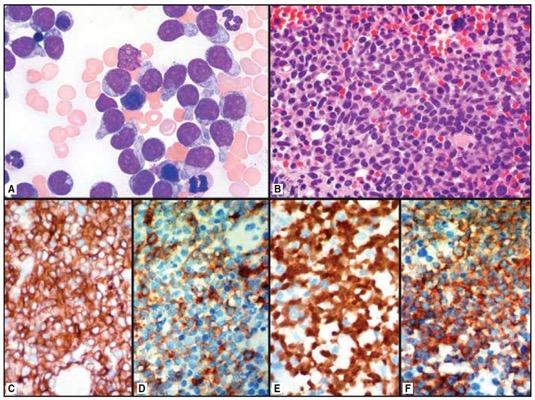 care Stem cell transplant (SCT) promising for select patients in remission BPDCN Bone Marrow H&E Riaz et al. Cancer Control, 2014; Pagano et al.
