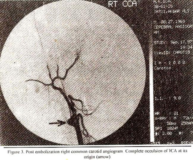 without any neurological deficit. Repeat left angiogram showed good tilling of right anterior and middle cerebral arteries by the anterior communicating artery.