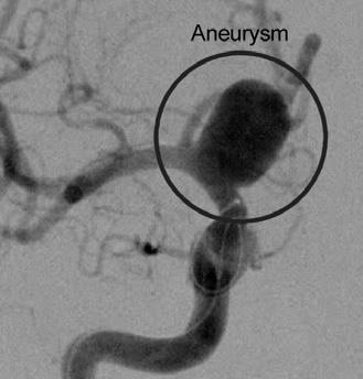 If a contrast dye is injected into a blood vessel, the brain blood vessels will be highlighted and aneurysms can be seen using special imaging techniques.