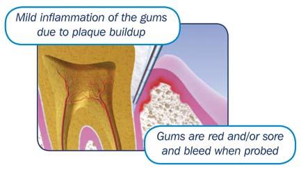 The Clinical Effect of a Stabilized Stannous Fluoride Dentifrice on Plaque Formation, Gingivitis and Gingival Bleeding: A Six-Month Study Gingivitis: A Prelude to Periodontitis?