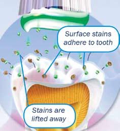Stain Removal : Remove Extrinsic Stain From Tooth Surface 0.454% Stannous Fluoride Dentifrice and Tooth Staining: Composite Evidence Demand for whiter teeth has grown dramatically in the past decade.