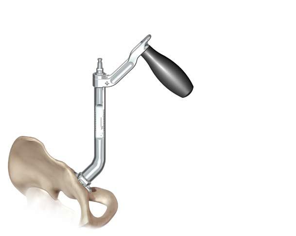 The creation of a hemispherical cavity with uniform bone-implant contact An adequate press-fit for initial stability Placement of the prosthesis at the anatomic centre of rotation of the hip joint,