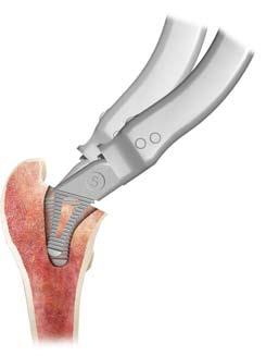 With this technique the surgeon is able to protect the soft tissues, maintain the cancellous bone and provide the best possible load delivery on the lateral flare.