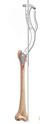 Alignment Check DePuy Proxima Hip is a conservative implant with no diaphyseal stem extension to facilitate alignment.
