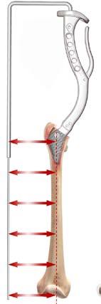 broaching. The alignment guide orbits the axis of the femur without pointing at any particular feature of the femur.