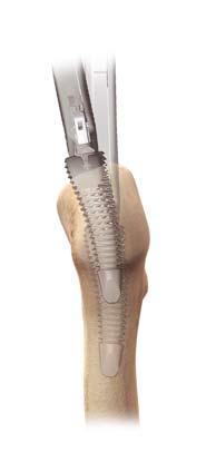 Broaching - Sequential Anatomic Preparation Sequential broaching is carried out with the left or right first anatomic starter (SL, SR) broach.
