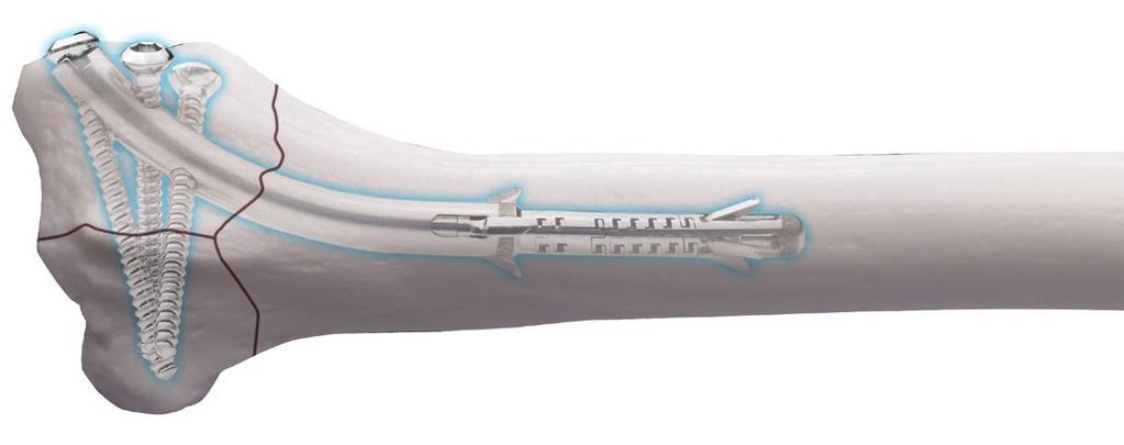 Minimally Invasive, Intramedullary Device For Distal Radius Fragility Fractures The Sonoma WRx Wrist Fracture Repair Device is flexible, inserting easily through a small incision over the radial