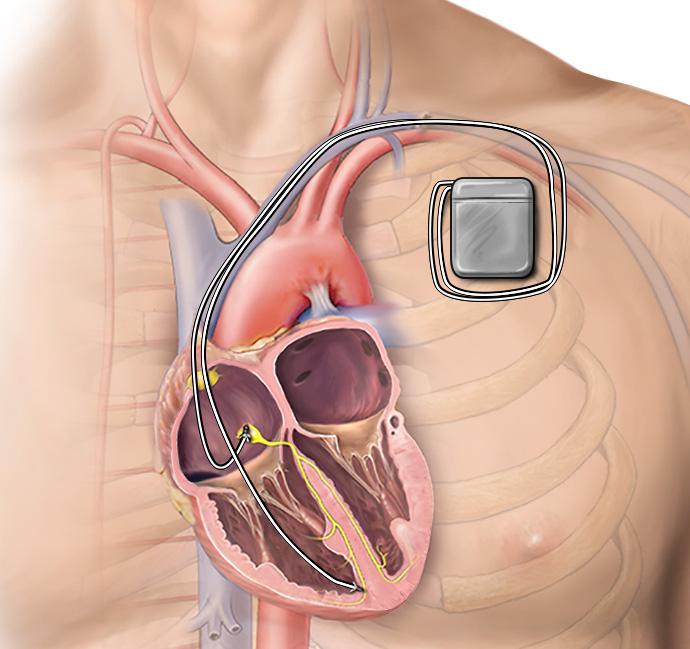 What is an internal cardioverter defibrillator? An internal cardioverter defibrillator (ICD) is a device that treats an abnormal heart rhythm.