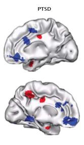 Neurocircuitry of PTSD: implications Traditional model Emotional Hyperactive Regulatory