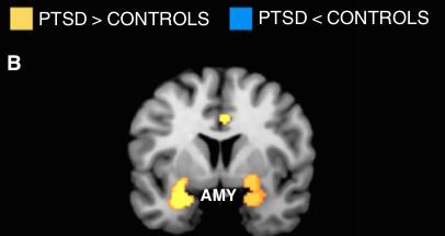 Amygdala amygdala responsitivity Childhood Trauma Questionnaire