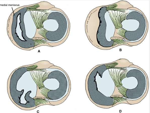 A. Complete bucket handle tear. B. The meniscus is torn from its peripheral attachment. The most common type of meniscus tear that causes locking is known as a bucket-handle tear.