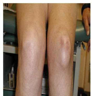 the ligamentum patellae Prepatellar bursitis ( housemaid's knee ) is