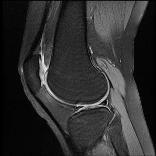 11-MRI of the knee: sagittal view QUADRICEPS TENDON SUPRAPATELLAR