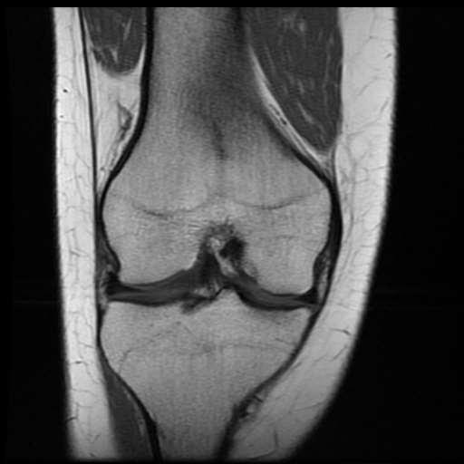 MRI of the knee: coronal plane FEMUR LATERAL MENISCUS POSTERIOR