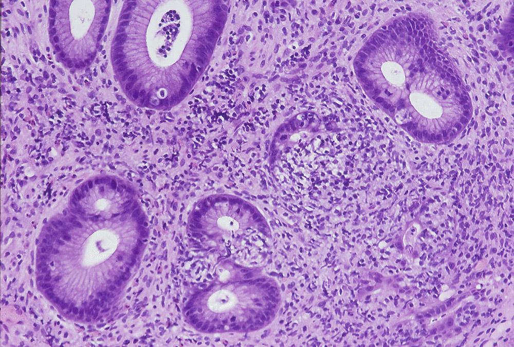 Gastric MALT 50% of primary gastric lymphomas Associated with HP infection (2/3) Molecular