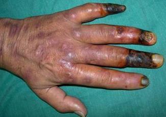 Relationship of hemodialysis access to finger gangrene in patients with ESRD Yeager, et al, JVS 2002 23 patients with finger gangrene with ipsilateral AVF Young diabetic