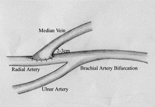 Proximal Radial Artery Fistula Alternative when wrist fistula not feasible Adequate arterial inflow but reduced risk of steal compared to brachial artery