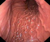 oesophagitis, gastroparesis & nonulcer dyspepsia ulcerative colitis, Crohn s disease, Coeliac disease 8 Regions of the stomach Pyloric
