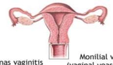 Unusual vaginal discharge or irritation