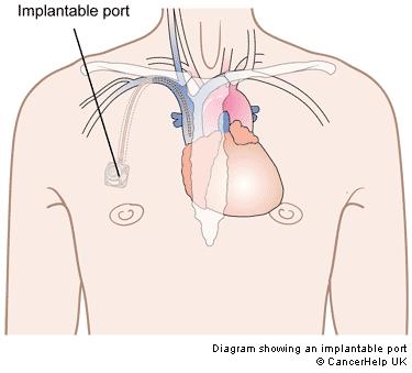 clamp and 10 cc syringe Access port at 90 degree angle Open clamp Aspirate 5 cc and discard then flush with 5 cc of normal saline Apply antibiotic ointment to puncture site and stabilize