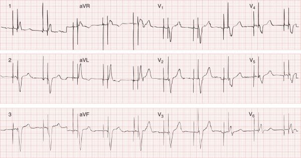 beats/min Pacemaker spike precedes QRS Note intrinsic QRS