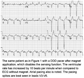 Failure to Sense Constant pacemaker spikes despite intrinsic cardiac activity