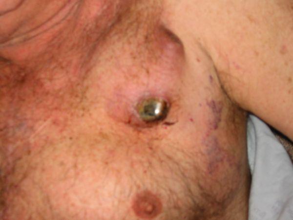 AICD Skin Erosion Site Infection