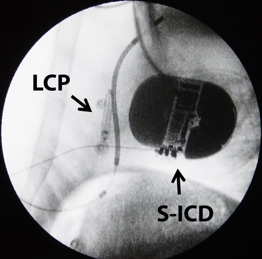 Animal Studies: S-ICD and Leadless ATP pacemaker