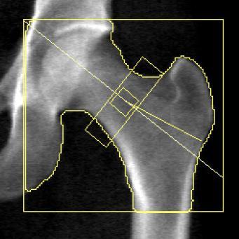 Figure 2.6: Example proximal femur DXA scan. Lines show the boundaries used to measure abmd.